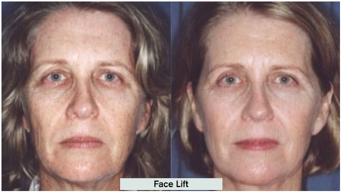 Face Lift Results