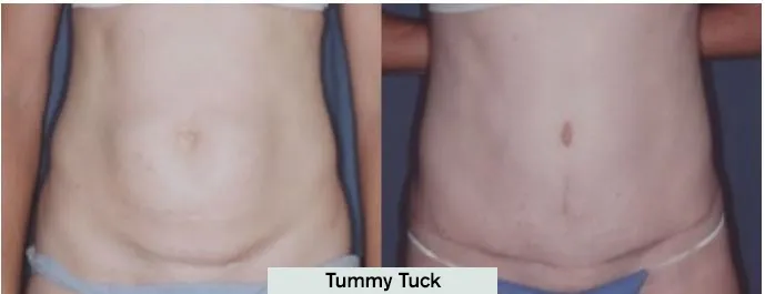 Tummy Tuck Results